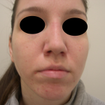 Rhinoplasty Before & After Patient #3851