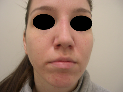 Rhinoplasty Before & After Patient #3851