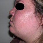 Liposuction Before & After Patient #3834