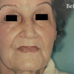 Facelift Before & After Patient #2665