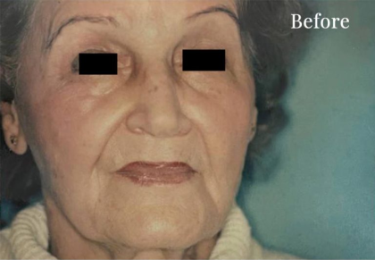 Facelift Before & After Patient #2665
