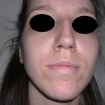 Rhinoplasty Before & After Patient #3851