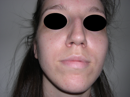 Rhinoplasty Before & After Patient #3851