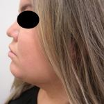 Liposuction Before & After Patient #3834