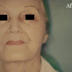 Facelift Before & After Patient #2665