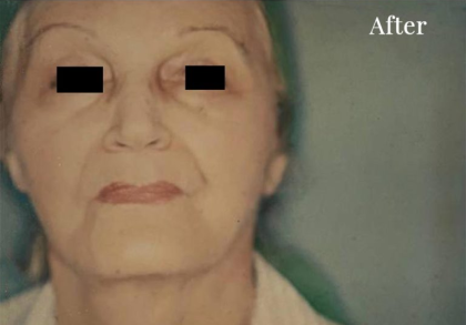 Facelift Before & After Patient #2665