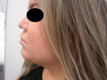 Liposuction Before & After Patient #3834