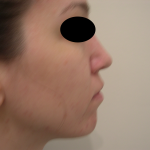 Rhinoplasty Before & After Patient #3851