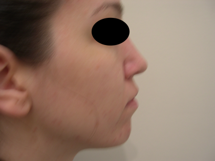 Rhinoplasty Before & After Patient #3851