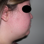 Liposuction Before & After Patient #3834