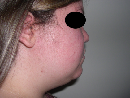 Liposuction Before & After Patient #3834