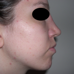 Rhinoplasty Before & After Patient #3851