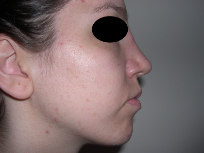Rhinoplasty Before & After Patient #3851