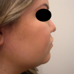 Liposuction Before & After Patient #3834