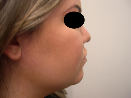 Liposuction Before & After Patient #3834