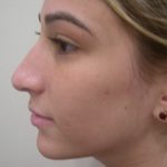 Rhinoplasty Before & After Patient #3846