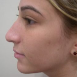 Rhinoplasty Before & After Patient #3846