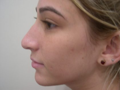 Rhinoplasty Before & After Patient #3846