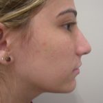 Rhinoplasty Before & After Patient #3846