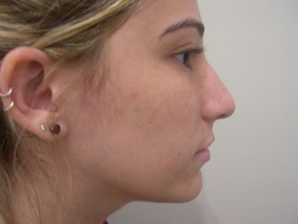 Rhinoplasty Before & After Patient #3846