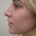 Rhinoplasty Before & After Patient #3846