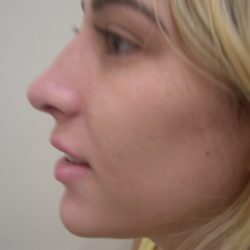 Rhinoplasty Before & After Patient #3846