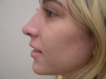 Rhinoplasty Before & After Patient #3846