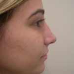 Rhinoplasty Before & After Patient #3846