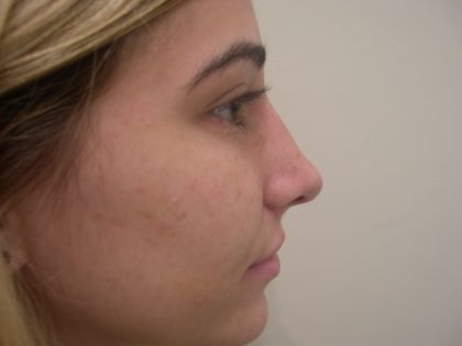 Rhinoplasty Before & After Patient #3846