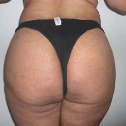 Buttock Augmentation Before & After Patient #4104