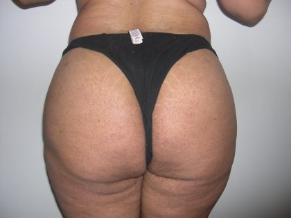 Buttock Augmentation Before & After Patient #4104