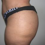 Buttock Augmentation Before & After Patient #4104
