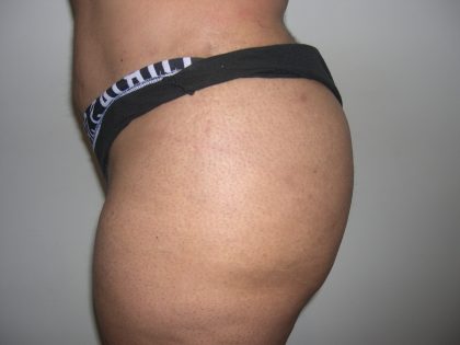 Buttock Augmentation Before & After Patient #4104