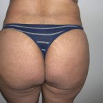 Buttock Augmentation Before & After Patient #4104