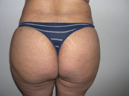 Buttock Augmentation Before & After Patient #4104