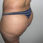 Buttock Augmentation Before & After Patient #4104