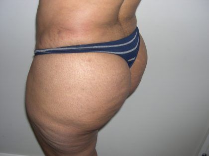 Buttock Augmentation Before & After Patient #4104