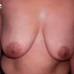 Mommy Makeover Before & After Patient #2939