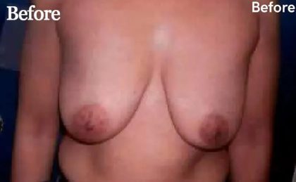 Mommy Makeover Before & After Patient #2939