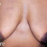 Mommy Makeover Before & After Patient #2929