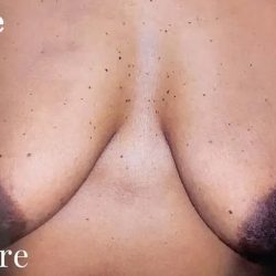 Mommy Makeover Before & After Patient #2929