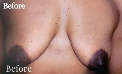 Mommy Makeover Before & After Patient #2929