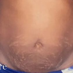 Mommy Makeover Before & After Patient #2949