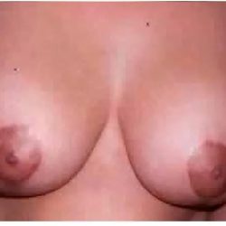 Mommy Makeover Before & After Patient #2939