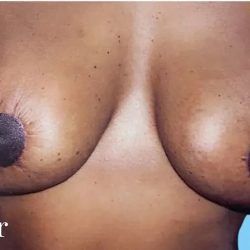 Mommy Makeover Before & After Patient #2929