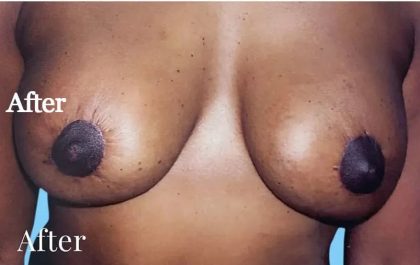 Mommy Makeover Before & After Patient #2929