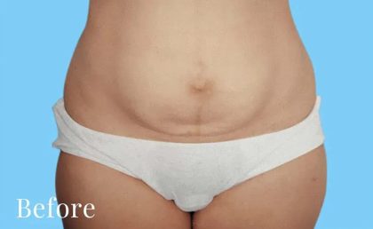 Mommy Makeover Before & After Patient #2939