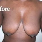 Mommy Makeover Before & After Patient #2949