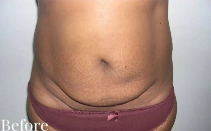 Mommy Makeover Before & After Patient #2929