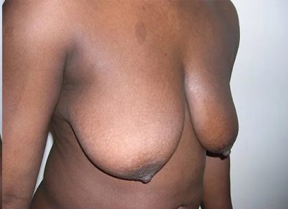 Breast Lift Before & After Patient #2283